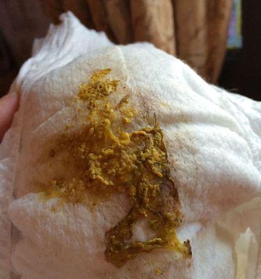 小便深棕色的原因及处理方法（了解为什么小便颜色变深以及如何处理）