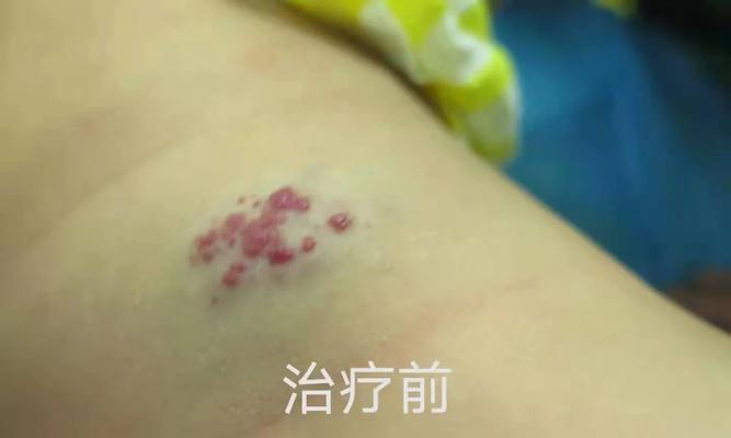 揭开皮下肿块的成因之谜（探索皮下肿块形成的原因及处理方法）