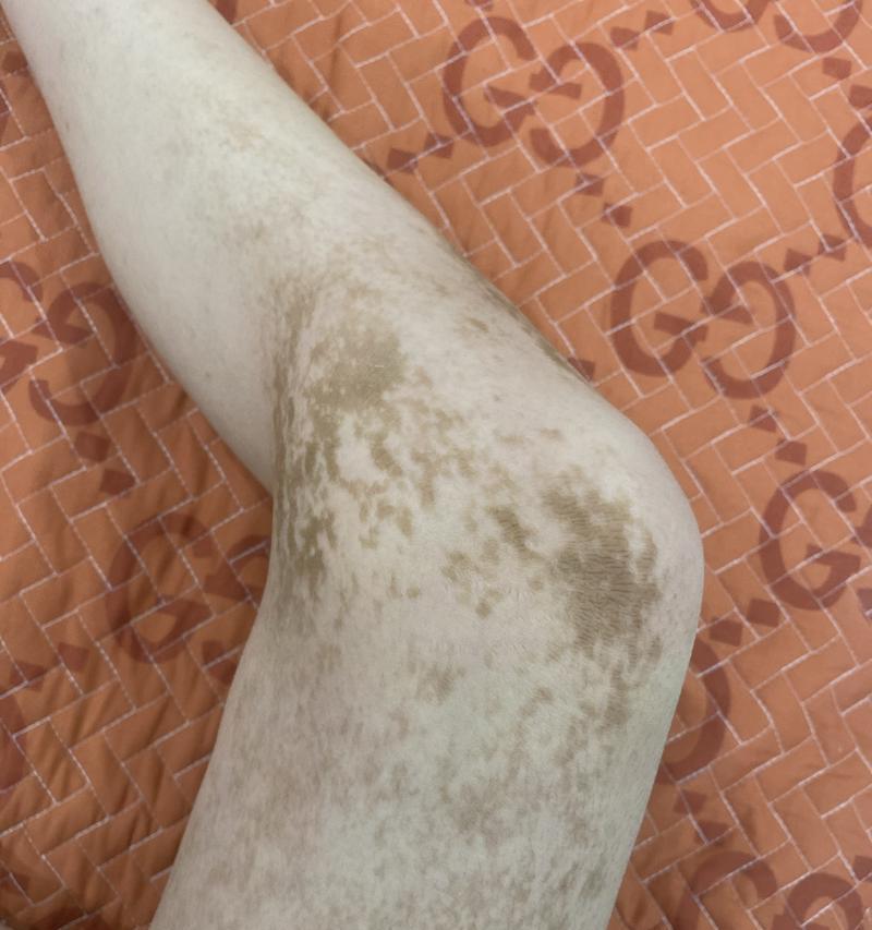 腿上常见的皮肤病及治疗方法（了解各种腿部皮肤问题，保护您的双腿健康）