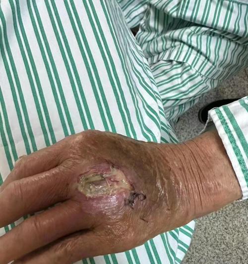 被狗咬了要打什么？——应对狗咬伤的正确方法（狗咬伤后的急救措施与治疗方式，）