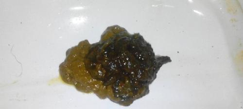 黑大便（了解黑大便的原因，及时预防和治疗）