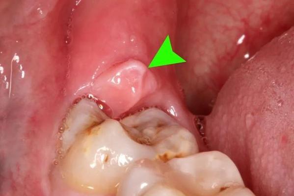 拔甲狗的疼痛过多久会消失？（了解拔甲狗的疼痛恢复时间和护理方法）